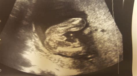 dating scan accuracy at 16 weeks